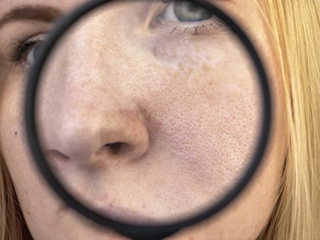 dark spots on face Пигментни петна по лицето