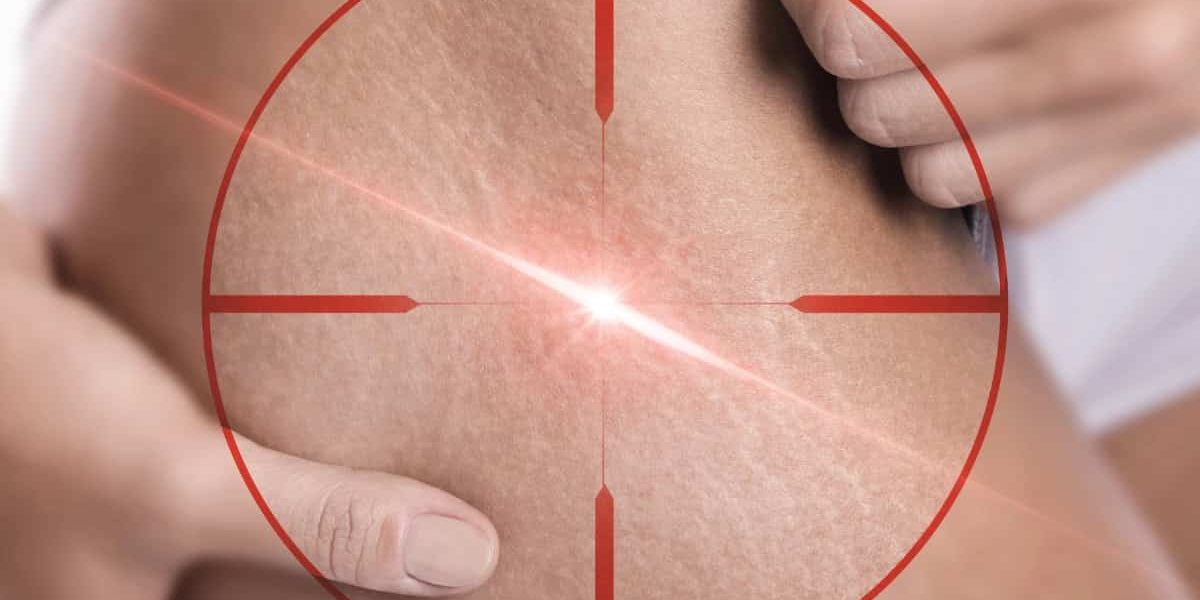 stretch mark removal Премахване на стрии