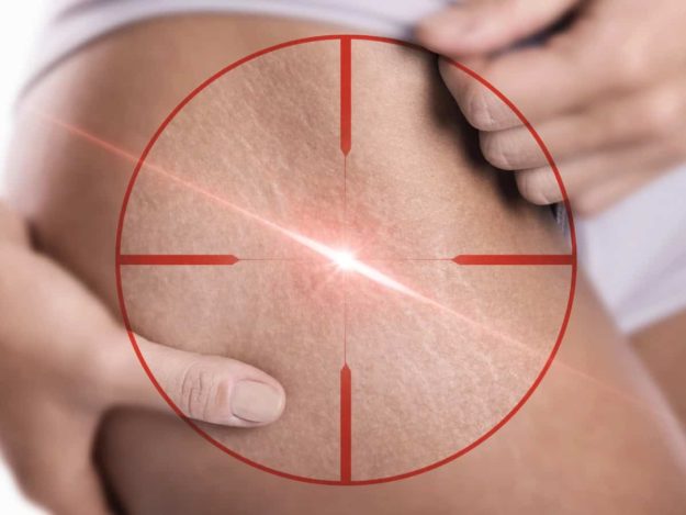 stretch mark removal Премахване на стрии
